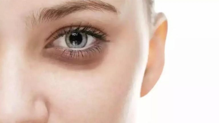 GÖZ ÇEVRESİNDE YAŞLANMAYI ÖNLEMEK İÇİN NELER YAPILABİLİR?