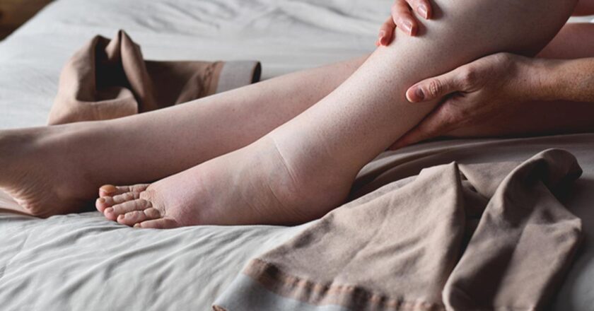 Bir ayağınız diğerinden büyükse dikkat: Tek taraflı şişlik lenfödem habercisi olabilir